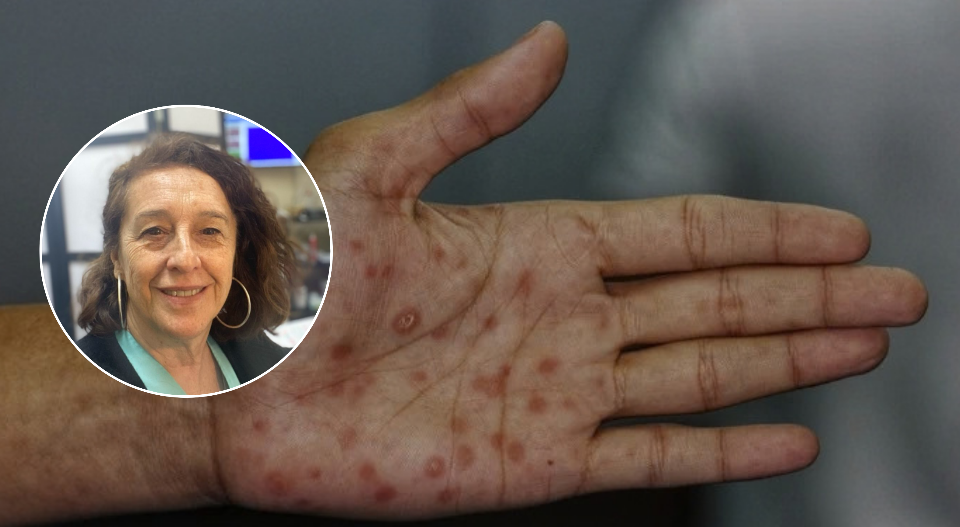 La Dra. Duvivier advirtió por el crecimiento de las ITS y pidió reforzar la prevención